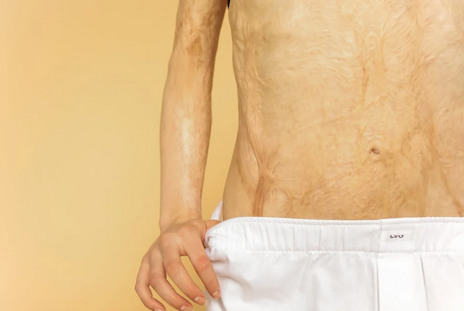 burn injury